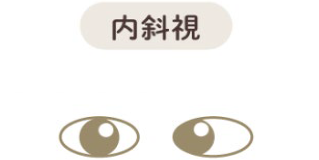 内斜視