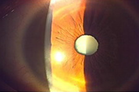 進行した白内障