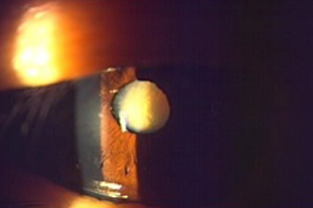 白内障（手術前）