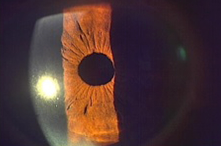 白内障（手術後）