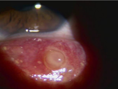 内側に突出した霰粒腫
