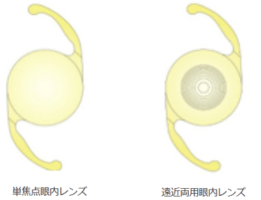眼内レンズ
