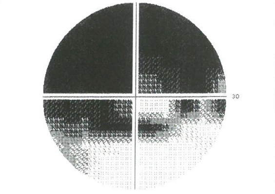 視野欠損のある眼