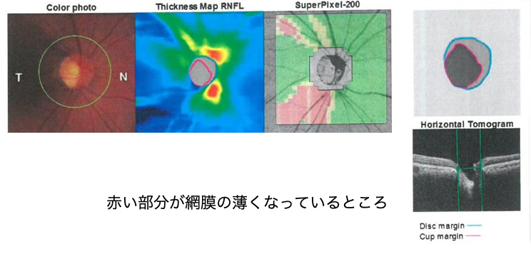 三次元画像解析装置(OCT)