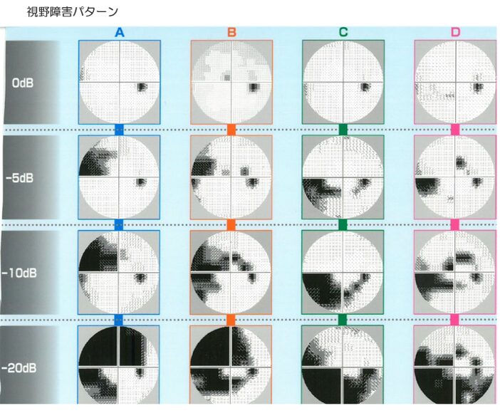 視野障害パターン