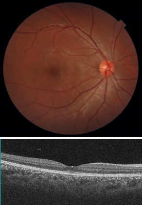 上図 / 正常な眼底写真
下図 / 正常なOCT