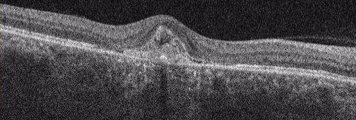 三次元眼底画像解析装置（OCT）