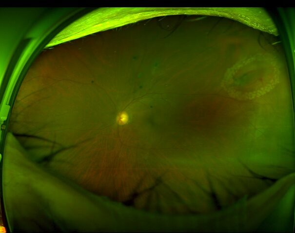 網膜裂孔レーザー後