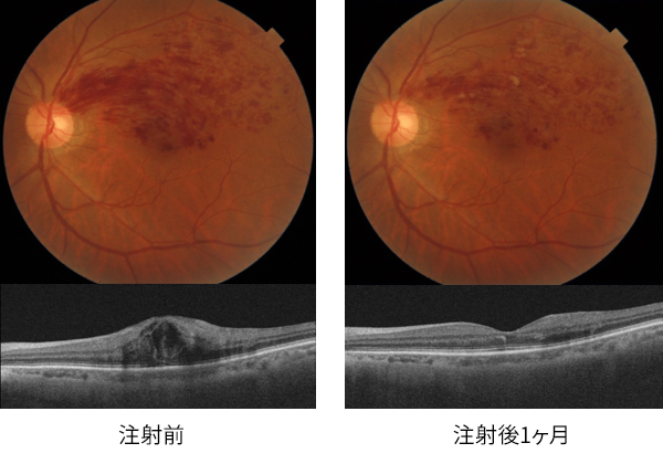 抗ＶＥＧＦ注射