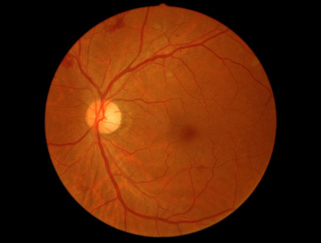 単純糖尿病網膜症