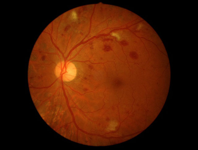 前増殖糖尿病網膜症