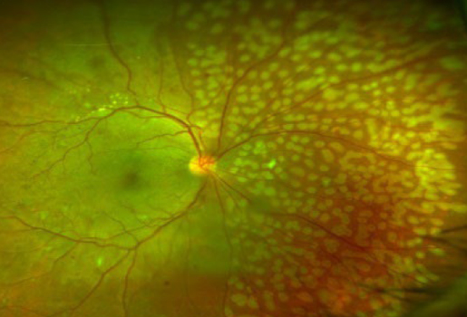 レーザー光凝固とは？