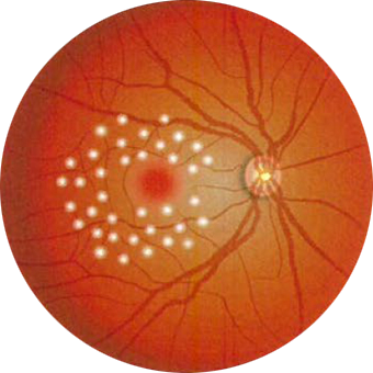 格子状光凝固（こうしじょうひかりぎょうこ）