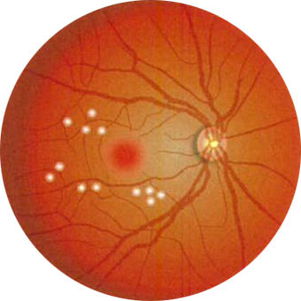 局所光凝固（きょくしょひかりぎょうこ）