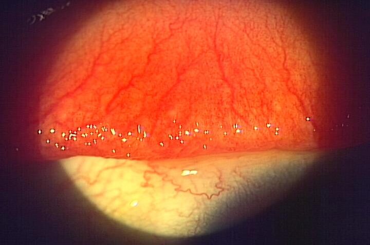 アレルギー性結膜炎