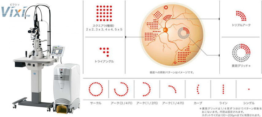 スキャンレーザー光凝固装置（NIDEK社）