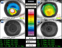 角膜形状解析装置（トポグラフイー）