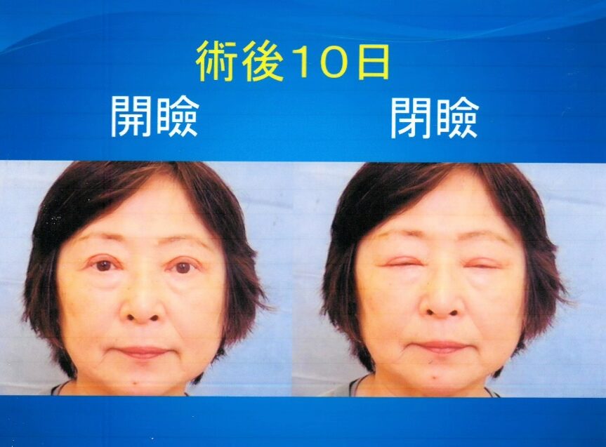 眼瞼下垂の手術