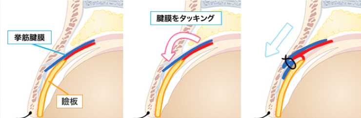 ミューラー筋タッキング法