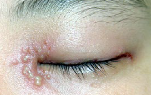 ヘルペスによる皮膚炎