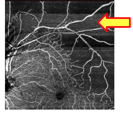 中心静脈分枝閉塞症（血流が途絶している）