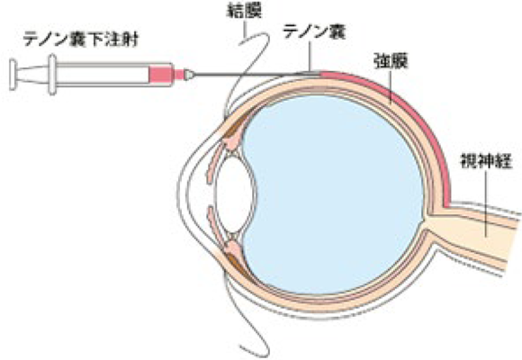 ステロイドのテノン嚢下注射